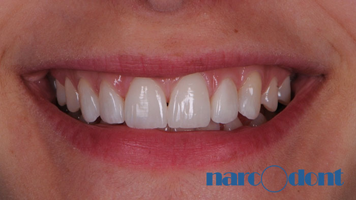 Narcodont-Riabilitazione_estetica_del_sorriso_mediante_faccette_in_ceramica-2 Dentista Milano Narcodont - Casi clinici