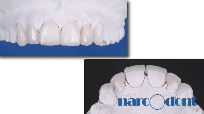Narcodont-Riabilitazione_estetica_del_sorriso_mediante_faccette_in_ceramica-3 Dentista Milano Narcodont - Casi clinici
