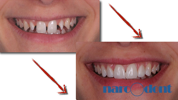 Narcodont-Riabilitazione_estetica_del_sorriso_mediante_faccette_in_ceramica-4 Dentista Milano Narcodont - Casi clinici