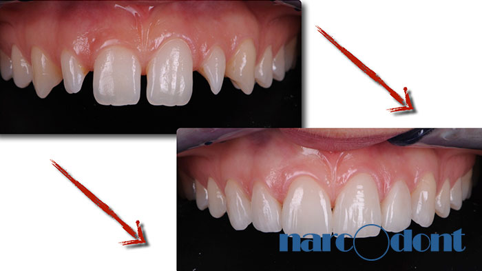 Narcodont-Riabilitazione_estetica_del_sorriso_mediante_faccette_in_ceramica-5 Dentista Milano Narcodont - Casi clinici