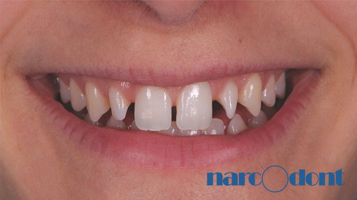 Narcodont-Riabilitazione_estetica_del_sorriso_mediante_faccette_in_ceramica Dentista Milano Narcodont - Casi clinici
