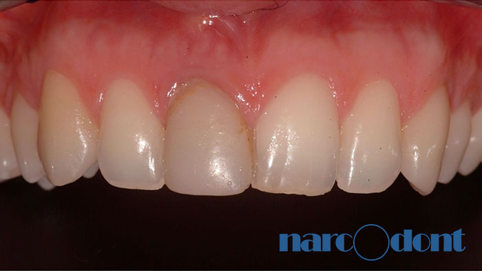 narcodont-Sostituzione_con_un_impianto-dentale_di_un_ncisivo_centrale_superiore-2 Dentista Milano Narcodont - Casi clinici