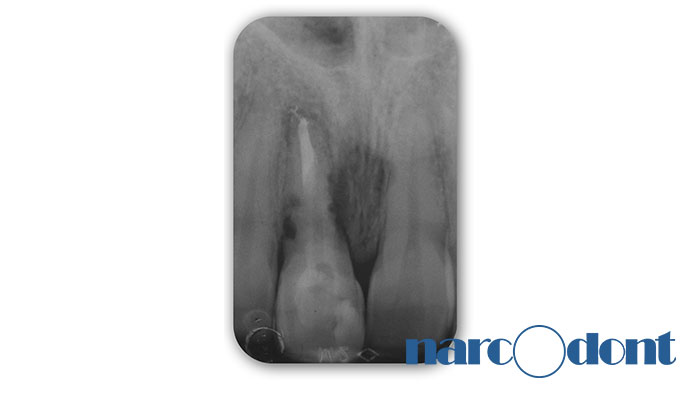 Dentista Milano Narcodont - Casi clinici
