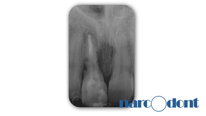 narcodont-Sostituzione_con_un_impianto-dentale_di_un_ncisivo_centrale_superiore-3 Dentista Milano Narcodont - Casi clinici