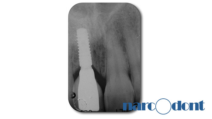 narcodont-Sostituzione_con_un_impianto-dentale_di_un_ncisivo_centrale_superiore-4 Dentista Milano Narcodont - Casi clinici
