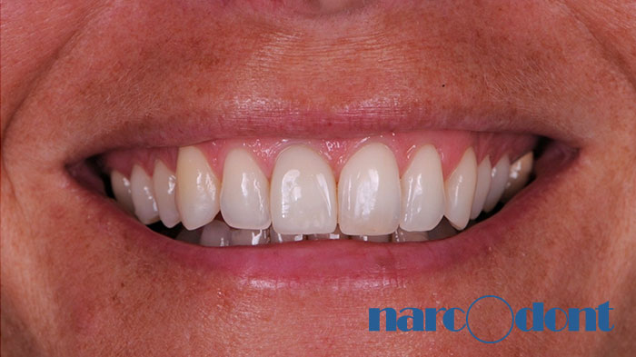 narcodont-Sostituzione_con_un_impianto-dentale_di_un_ncisivo_centrale_superiore-5 Dentista Milano Narcodont - Casi clinici