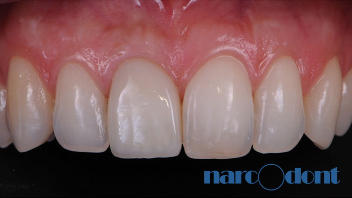 narcodont-Sostituzione_con_un_impianto-dentale_di_un_ncisivo_centrale_superiore Dentista Milano Narcodont - Casi clinici