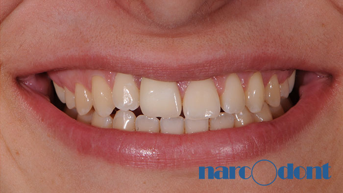 Dentista Milano Narcodont - Casi clinici