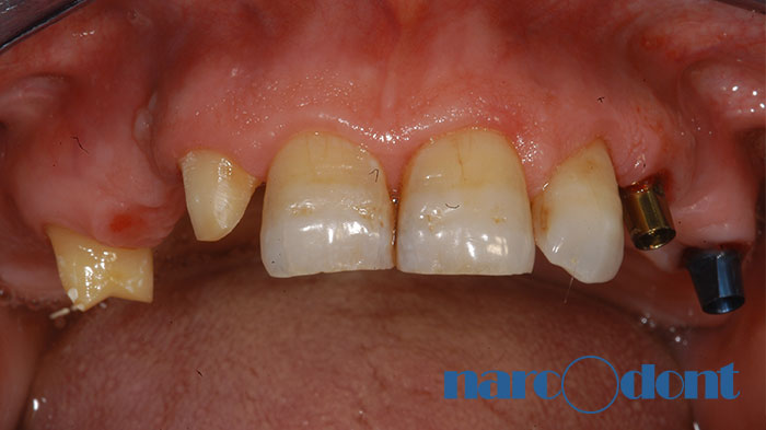 narcodont-Protesi_fissa_dellarcata_superiore_su_denti_e_su_impianti-1