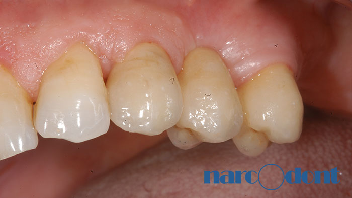 narcodont-Protesi_fissa_dellarcata_superiore_su_denti_e_su_impianti-2