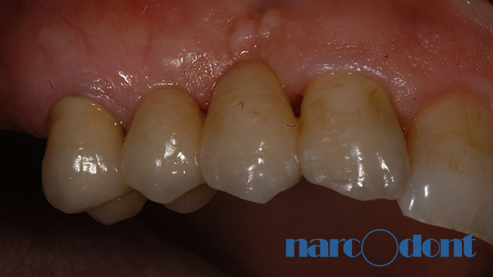 narcodont-Protesi_fissa_dellarcata_superiore_su_denti_e_su_impianti-3