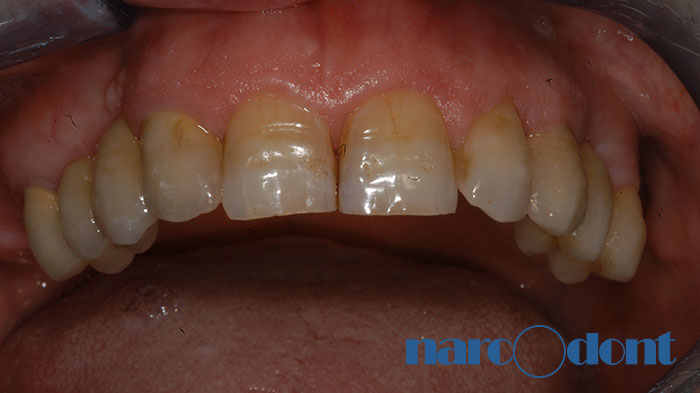 narcodont-Protesi_fissa_dellarcata_superiore_su_denti_e_su_impianti-4