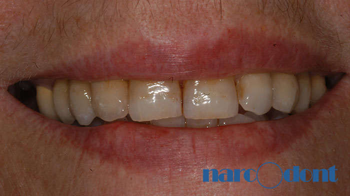 narcodont-Protesi_fissa_dellarcata_superiore_su_denti_e_su_impianti-5