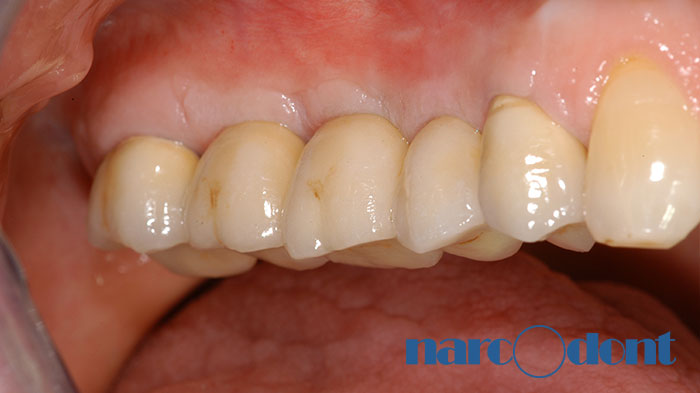 narcodont-Riabilitazione_implanto-protesica_di_parte_dellarcata_superiore-2