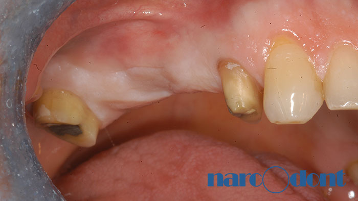 narcodont-Riabilitazione_implanto-protesica_di_parte_dellarcata_superiore-3